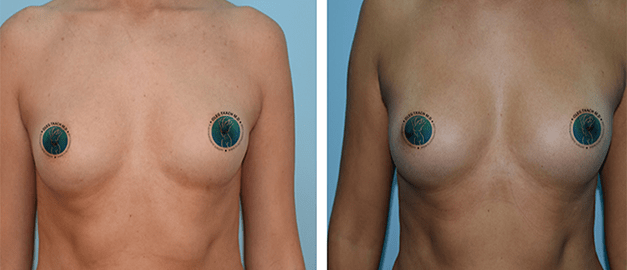 Фото до и после Липофилинг груди 18