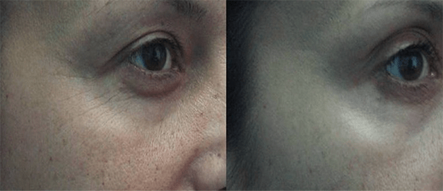 Фото до и после Инъекции ботулотоксина 3