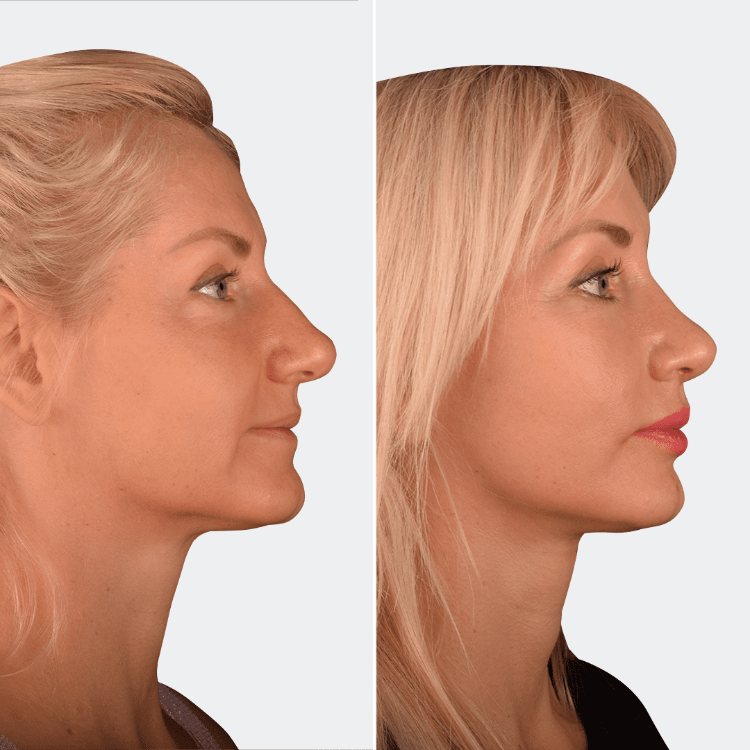 Фото до и после Ринопластика (пластика носа) 19