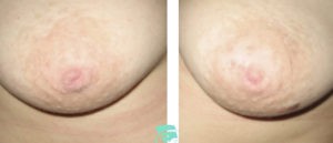 Photos before and after Nipple Correction/Areola correction 7