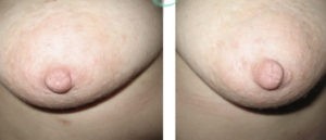 Photos before and after Nipple Correction/Areola correction 4