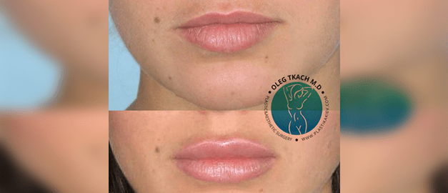 Photos before and after Сheiloplasty 20