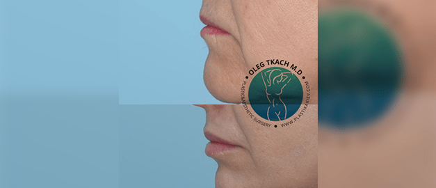 Photos before and after Laser Facial Skin Resurfacing 8