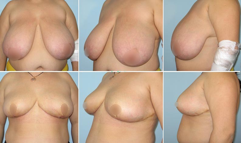 Фото до и после Уменьшение груди 3