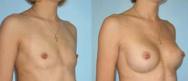 Фото до и после Маммопластика (увеличение груди) 41