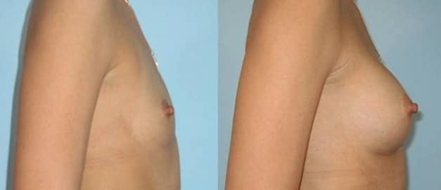 Фото до и после Маммопластика (увеличение груди) 42