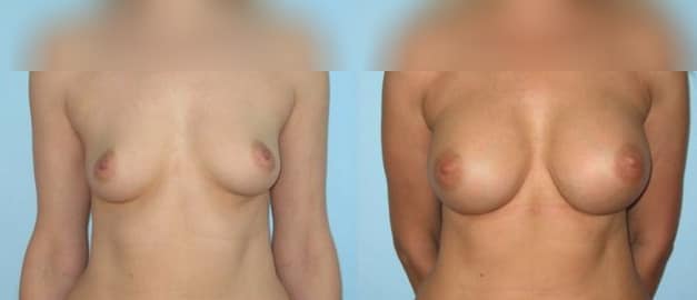 Фото до и после Маммопластика (увеличение груди) 22