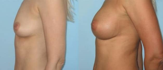 Фото до и после Маммопластика (увеличение груди) 21