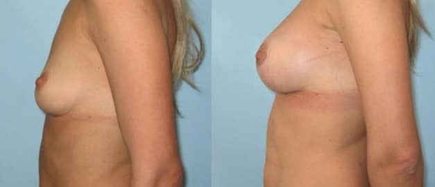 Фото до и после Маммопластика (увеличение груди) 44