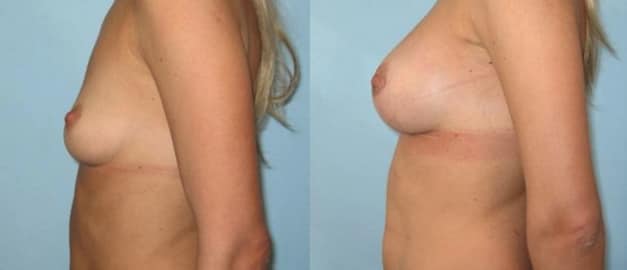 Фото до та після Мамопластика (Збільшення грудей) 45