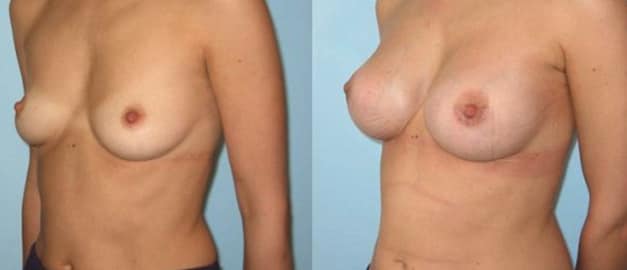 Фото до и после Маммопластика (увеличение груди) 53