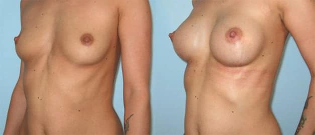 Фото до и после Маммопластика (увеличение груди) 46