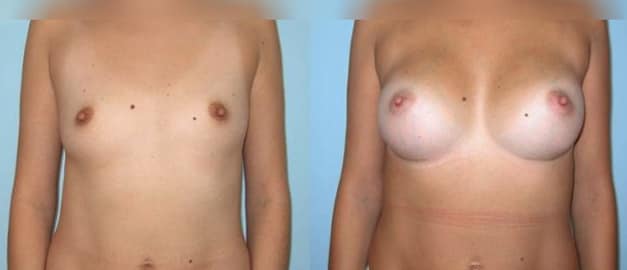 Фото до и после Маммопластика (увеличение груди) 36