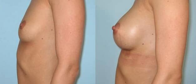 Фото до и после Маммопластика (увеличение груди) 47