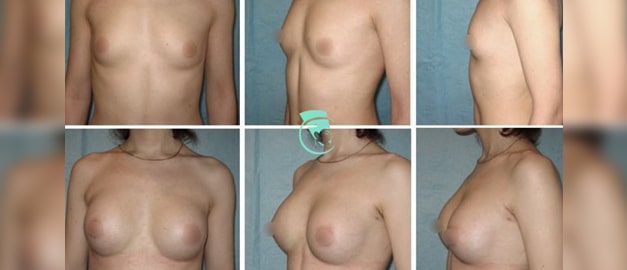 Фото до и после Маммопластика (увеличение груди) 51