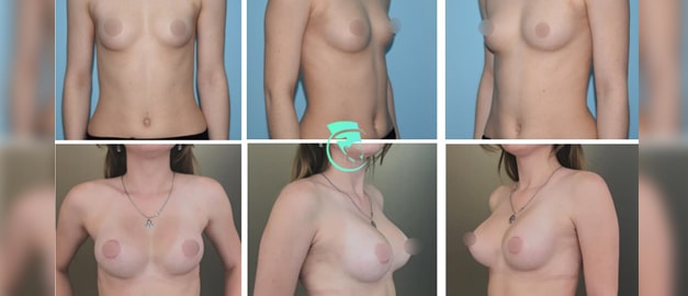 Фото до и после Маммопластика (увеличение груди) 55
