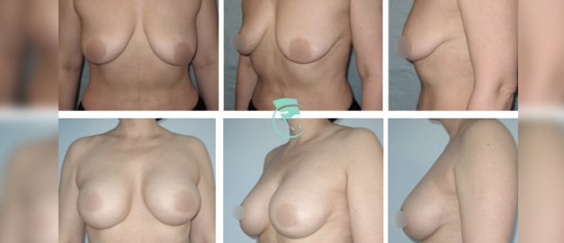 Фото до и после Маммопластика (увеличение груди) 56