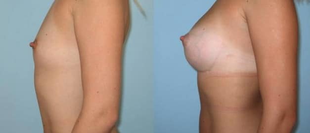 Фото до и после Маммопластика (увеличение груди) 37