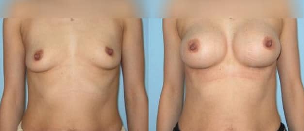 Фото до и после Маммопластика (увеличение груди) 38