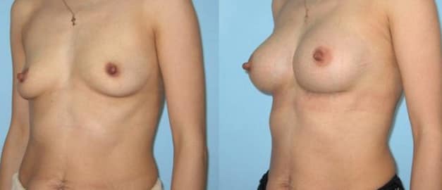 Фото до и после Маммопластика (увеличение груди) 39