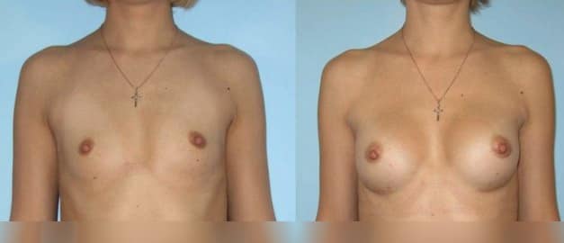 Фото до и после Маммопластика (увеличение груди) 40