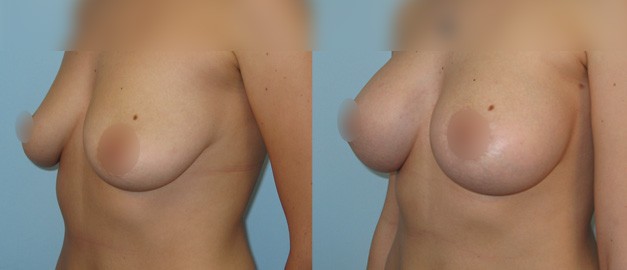 Фото до и после Маммопластика (увеличение груди) 59