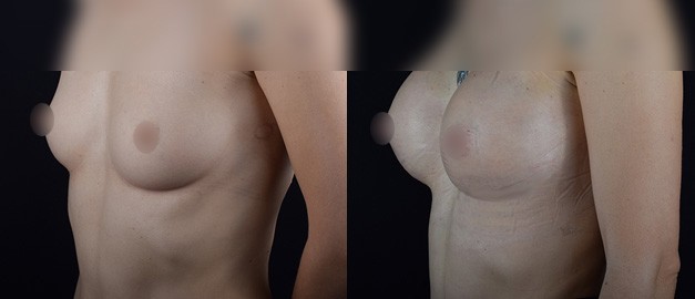 Фото до и после Маммопластика (увеличение груди) 48
