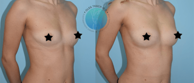 Фото до и после Липофилинг груди 20