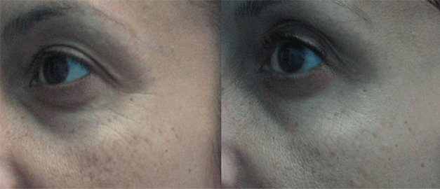 Фото до и после Инъекции ботулотоксина 4