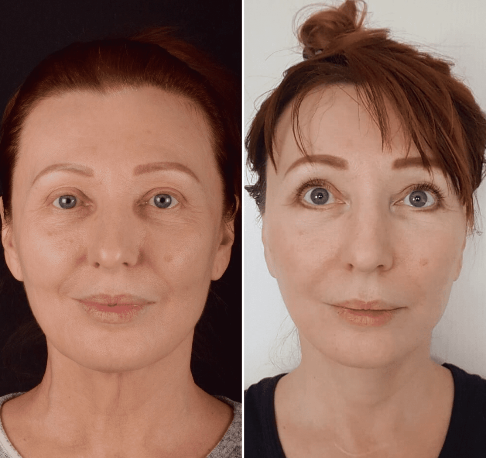 Фото до и после Подтяжка лица 19