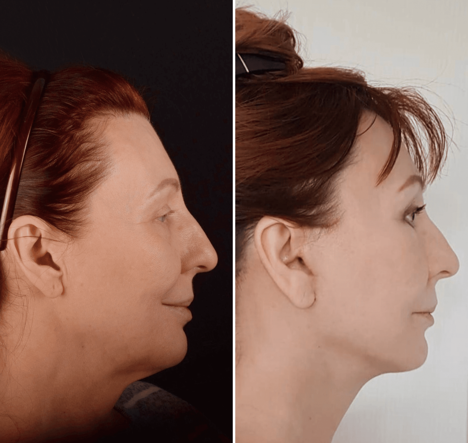 Фото до и после Подтяжка лица 21