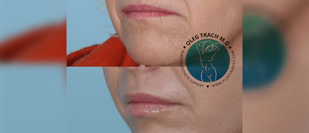 Фото до та після Лазерне шліфування шкіри обличчя 9