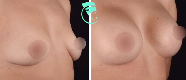 Фото до и после Маммопластика (увеличение груди) 31