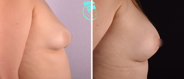 Фото до та після Мамопластика (Збільшення грудей) 33