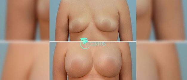 Фото до и после Маммопластика (увеличение груди) 30