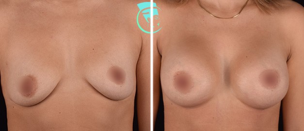 Фото до и после Маммопластика (увеличение груди) 34