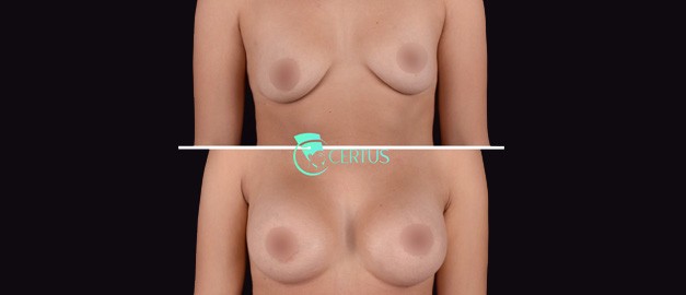Фото до и после Маммопластика (увеличение груди) 29