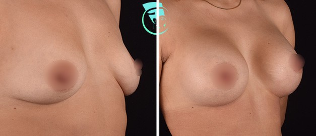 Фото до и после Маммопластика (увеличение груди) 35
