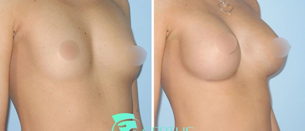 Фото до и после Маммопластика (увеличение груди) 28