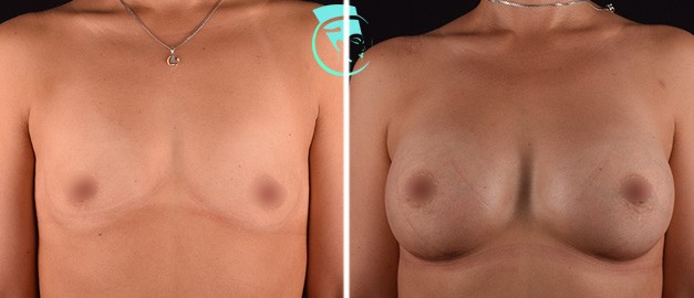 Фото до и после Маммопластика (увеличение груди) 23