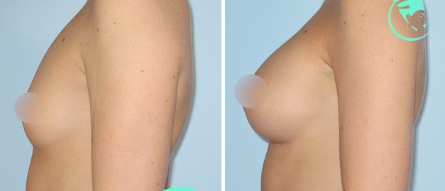 Фото до и после Маммопластика (увеличение груди) 32