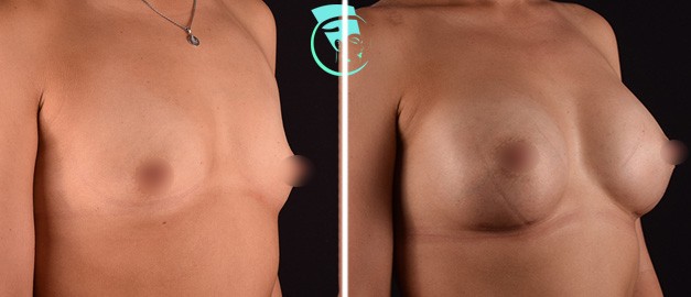 Фото до и после Маммопластика (увеличение груди) 24