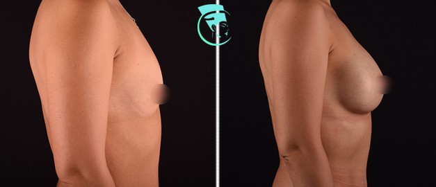 Фото до и после Маммопластика (увеличение груди) 25