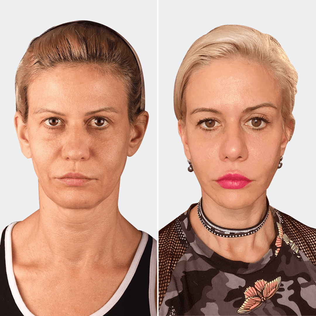 Фото до и после Подтяжка лица 14