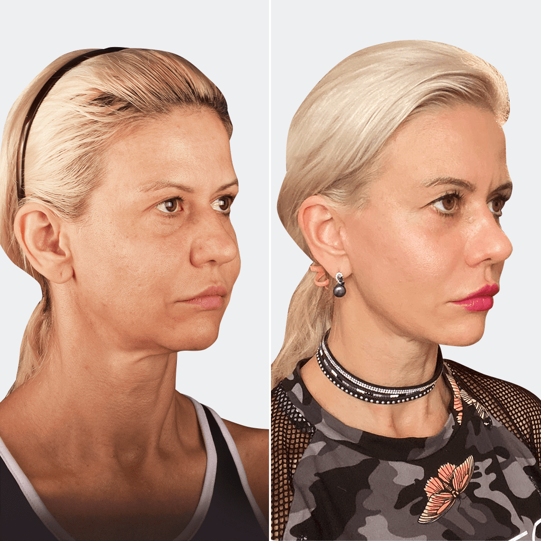Фото до та після Підтяжка обличчя 15