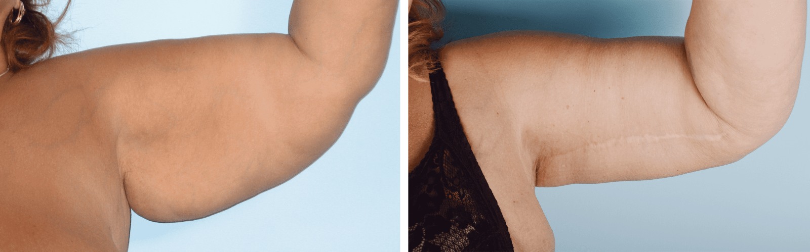 Фото до и после Подтяжка плечей (брахиопластика) 1