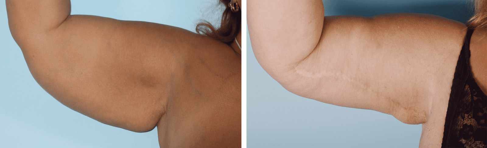 Фото до та після Підтяжка плечей (брахіопластика) 2
