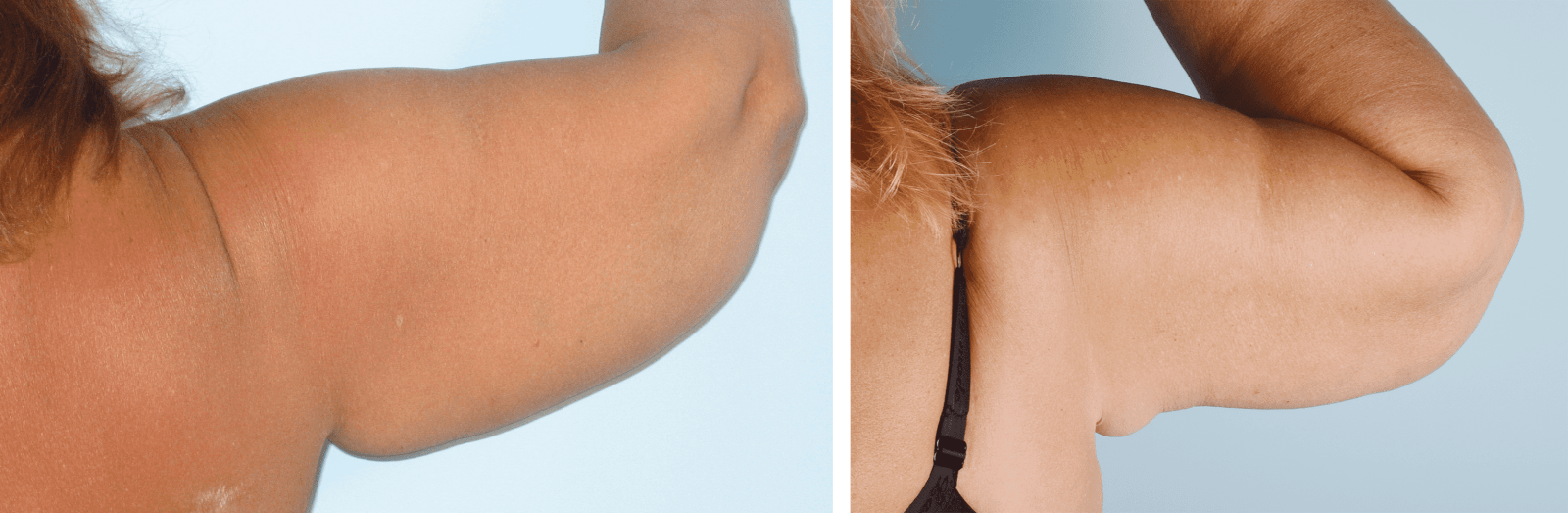 Фото до и после Подтяжка плечей (брахиопластика) 4