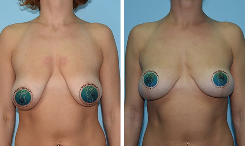 Фото до и после Уменьшение груди 16