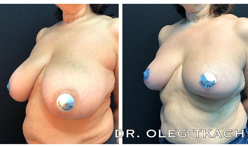 Фото до и после Уменьшение груди 14